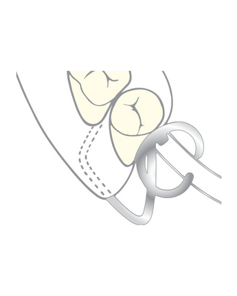 Scheu TK-klammer 10pack